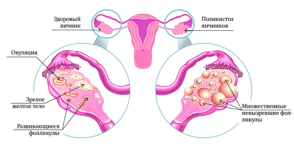 
			Синдром поликистозных яичников. В каких случаях следует заподозрить и как лечить		