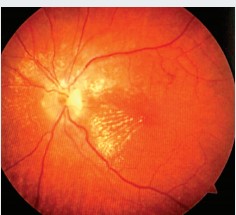 Аденома гипофиза и хиазмальный синдром. Часть 2. Методы лечения
Аденома гипофиза и хиазмальный синдром. Часть 2. Методы лечения