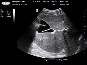 
			Аномалии развития билиарного тракта у детей и их клинико-патогенетическое значение		