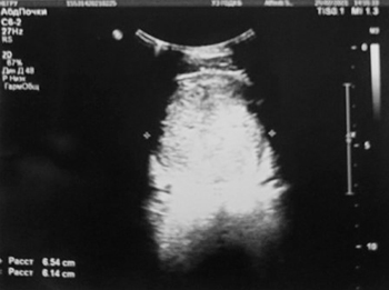 
			Нейрогенный мочевой пузырь		