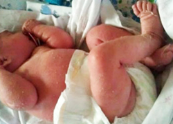 
			Ранняя диагностика тяжелых комбинированных иммунодефицитов		