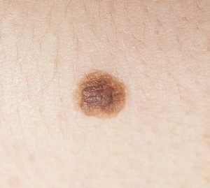 
			 О важности ранней диагностики меланомы кожи		