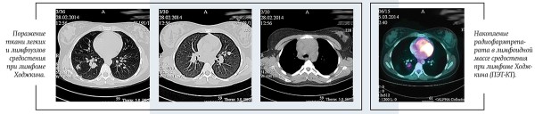 Лимфома Ходжкина у детей и подростков		 
			Лимфома Ходжкина у детей и подростков