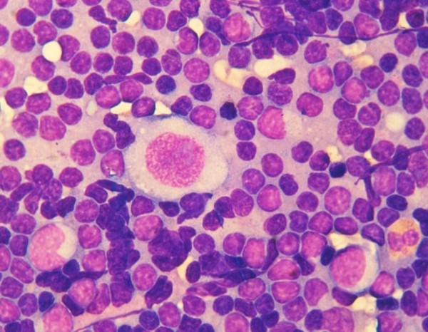 Лимфома Ходжкина у детей и подростков		 
			Лимфома Ходжкина у детей и подростков