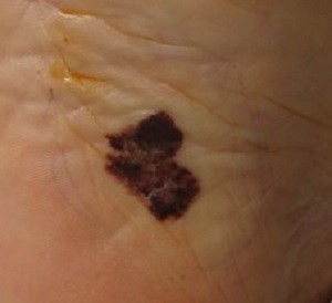 
			 О важности ранней диагностики меланомы кожи		