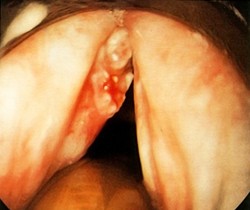 
			Предраковые заболевания гортани		