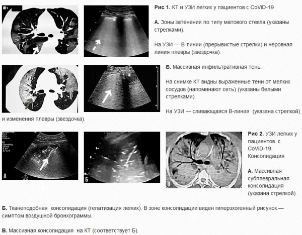 
			УЗИ легких у пациентов с CoViD-19: опыт китайских специалистов. Часть 1		
