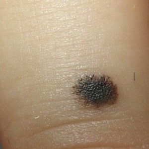 
			 О важности ранней диагностики меланомы кожи		