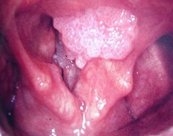 
			Предраковые заболевания гортани		