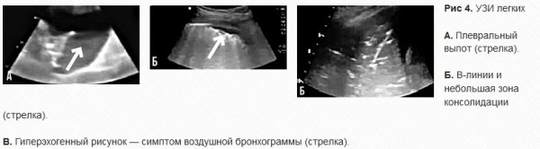 
			УЗИ легких у пациентов с CoViD-19: опыт китайских специалистов. Часть 1		