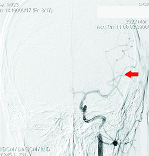 Острый ишемический инсульт у подростка: опыт комбинированного внутрисосудистого тромболизиса
Острый ишемический инсульт у подростка: опыт комбинированного внутрисосудистого тромболизиса