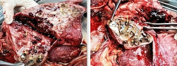 
        COVID-ассоциированный инвазивный легочный аспергиллез: проблемы диагностики и лечения			    