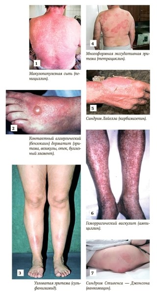 
        Важные вопросы лекарственной гиперчувствительности			    