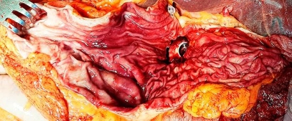 
        COVID-19-ассоциированные  изменения ЖКТ: данные ультразвуковых  и морфологических исследований			    