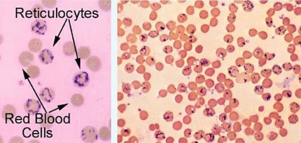
        Гемолитические анемии у детей: клиника и алгоритм диагностики			    