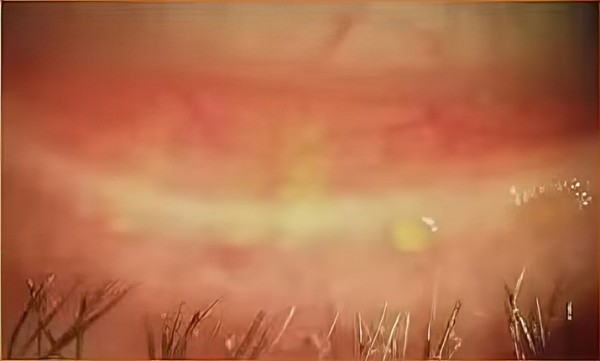 
        Инфицирование клещом  рода Demodex: хронический блефарит, дисфункция мейбомиевых желез и сухой глаз 			    