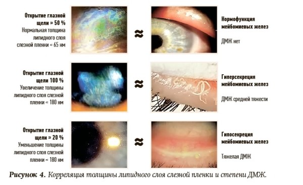 
        Инфицирование клещом  рода Demodex: хронический блефарит, дисфункция мейбомиевых желез и сухой глаз 			    
