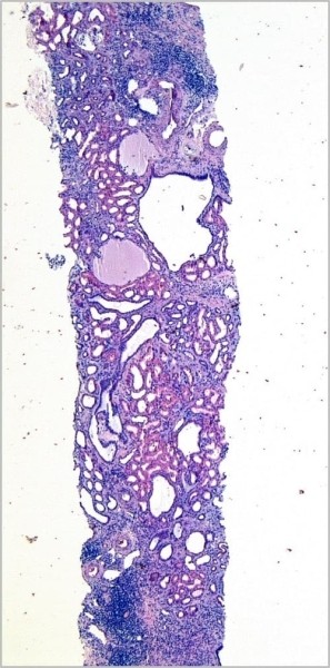 Морфологическая диагностика в детской нефрологии			     
        Морфологическая диагностика в детской нефрологии