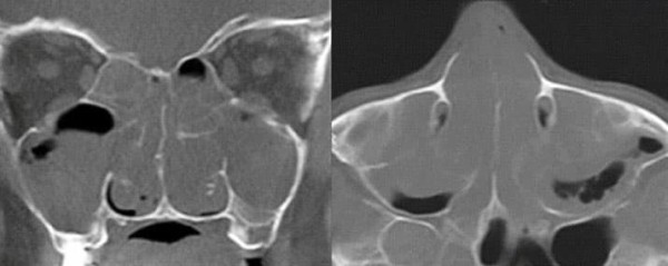 
        Состояние лор-органов у пациентов детского возраста с муковисцидозом			    