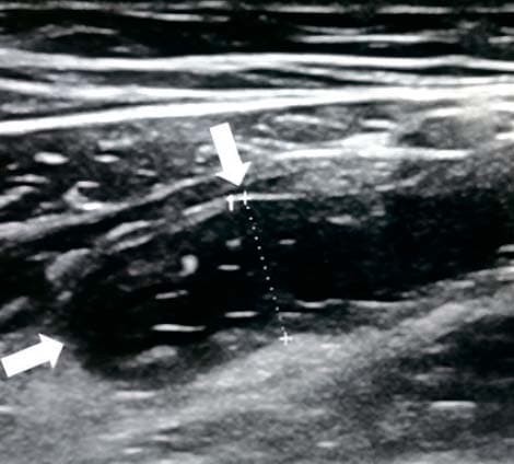 
        Алгоритм ультразвуковой диагностики острого аппендицита			    