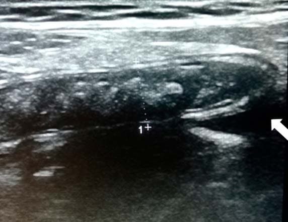 
        Алгоритм ультразвуковой диагностики острого аппендицита			    