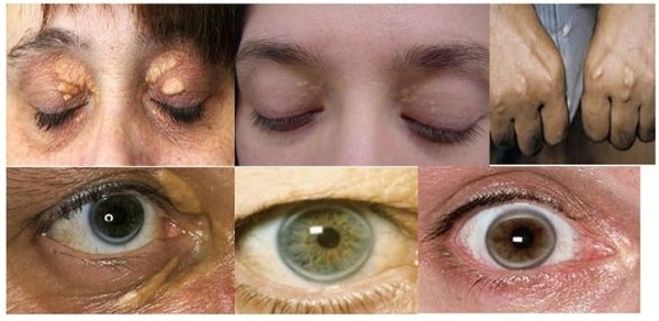 
        На повестке дня — дислипидемия			    