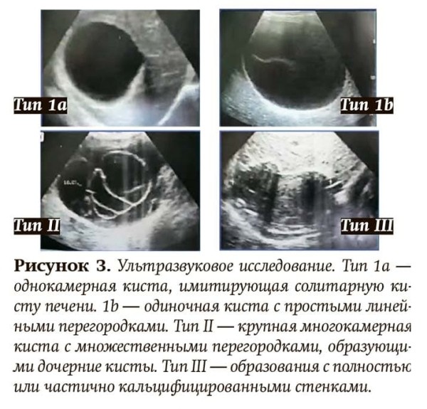 
        Эхинококкоз: как избежать послеоперационных рецидивов			    