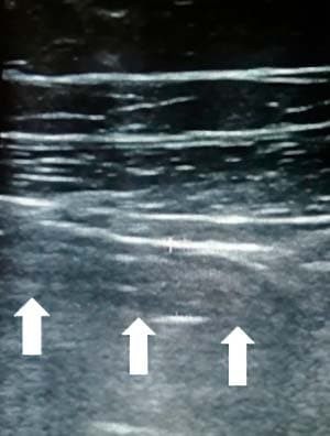 
        Алгоритм ультразвуковой диагностики острого аппендицита			    