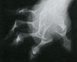 Псориатический артрит: диагностика и тактика ведения пациента
Псориатический артрит: диагностика и тактика ведения пациента