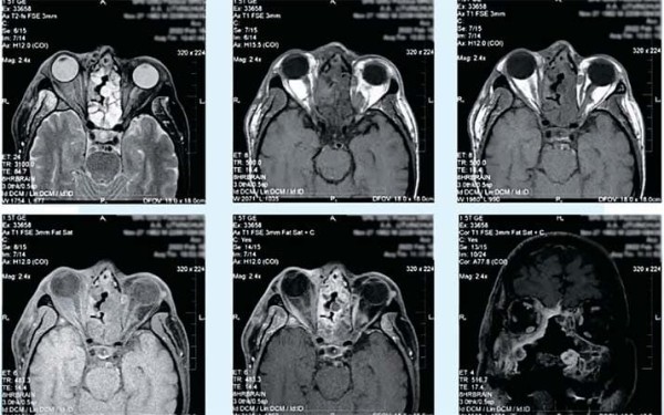 
        Постковидные остеонекрозы костей лицевого отдела черепа			    