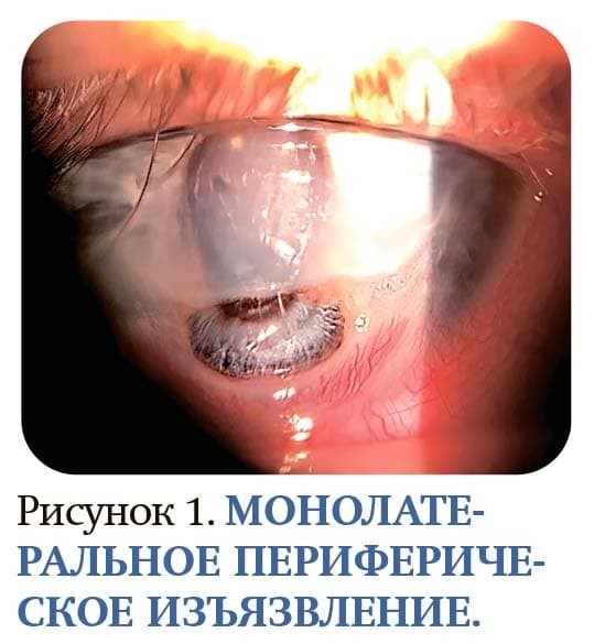 
        Хирургическое лечение периферических язв роговицы			    