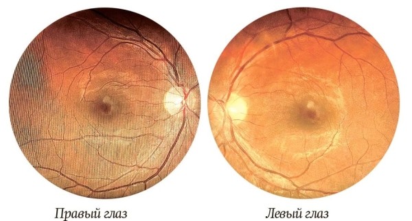 
        Внутриглазная миграция металлического инородного тела			    