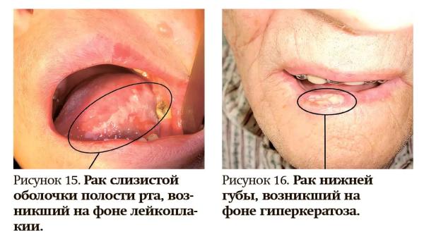 
        Клинические проявления предопухолевых заболеваний и рака полости рта			    