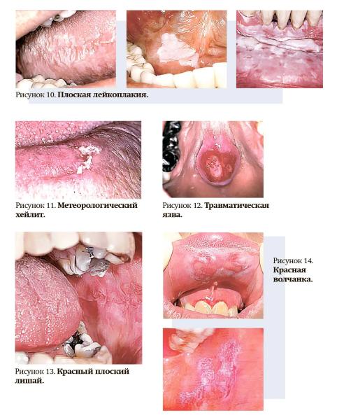 
        Клинические проявления предопухолевых заболеваний и рака полости рта			    