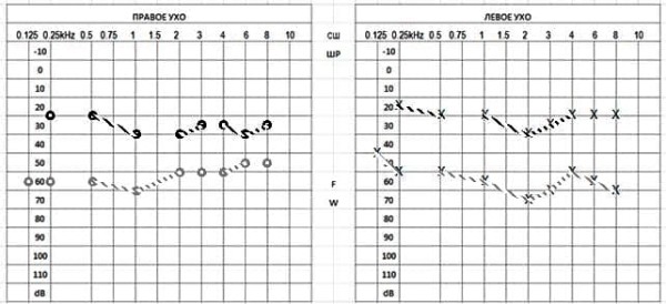 
        Клинический случай семейного отосклероза                    