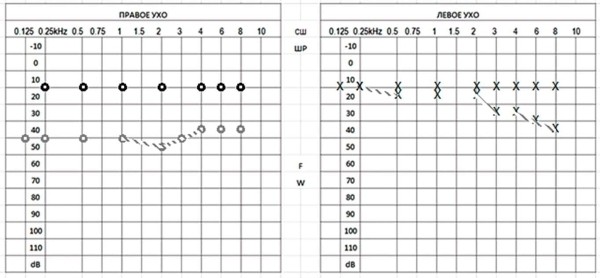 
        Клинический случай семейного отосклероза                    