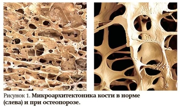 
        Остеопороз в клинической практике                    