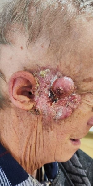 
        Лучевая терапия как вариант лечения нерезектабельных местно-распространенных опухолей кожи                    