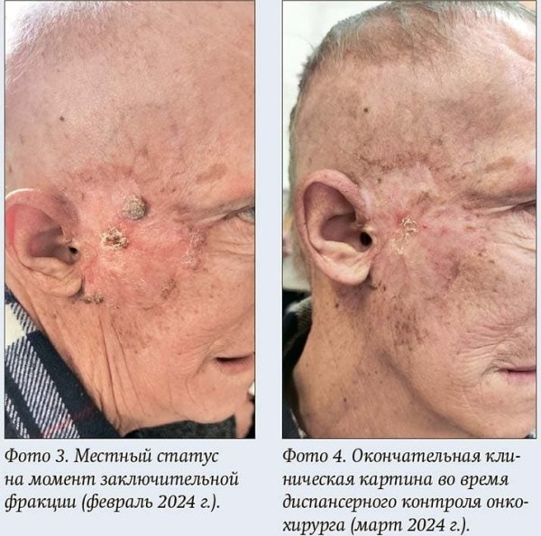 
        Лучевая терапия как вариант лечения нерезектабельных местно-распространенных опухолей кожи                    