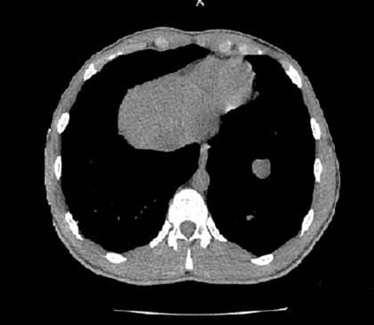Тестикулярные герминогенные опухоли
Тестикулярные герминогенные опухоли