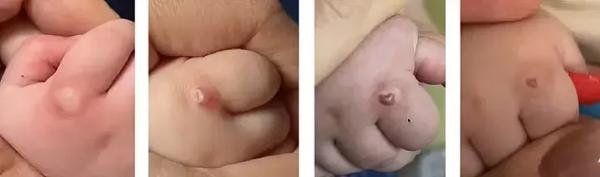 Синдром активации тучных клеток. Почему не всегда возможно добиться контроля течения аллергических заболеваний?                     
        Синдром активации тучных клеток. Почему не всегда возможно добиться контроля течения аллергических заболеваний?