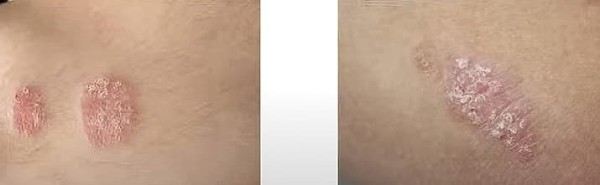 Синдром активации тучных клеток. Почему не всегда возможно добиться контроля течения аллергических заболеваний?                     
        Синдром активации тучных клеток. Почему не всегда возможно добиться контроля течения аллергических заболеваний?