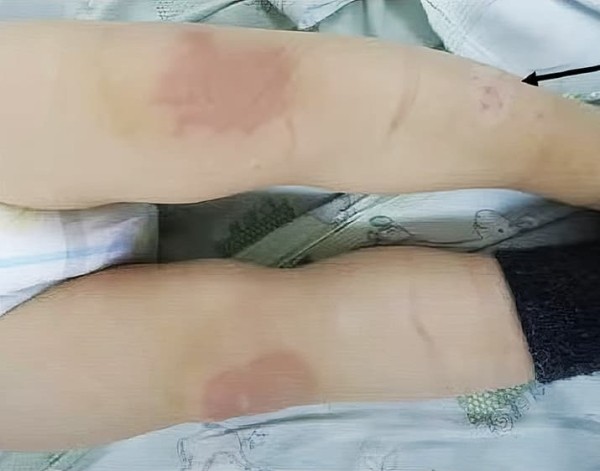 Синдром активации тучных клеток. Почему не всегда возможно добиться контроля течения аллергических заболеваний?                     
        Синдром активации тучных клеток. Почему не всегда возможно добиться контроля течения аллергических заболеваний?