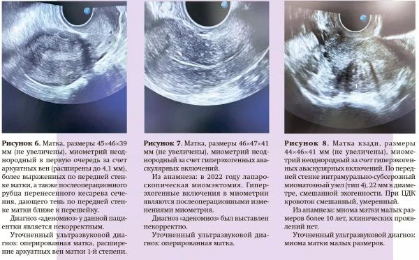 Примеры ошибок и гипердиагностика аденомиоза при проведении УЗ-исследований                     
        Примеры ошибок и гипердиагностика аденомиоза при проведении УЗ-исследований