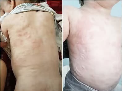 Синдром активации тучных клеток. Почему не всегда возможно добиться контроля течения аллергических заболеваний?                     
        Синдром активации тучных клеток. Почему не всегда возможно добиться контроля течения аллергических заболеваний?