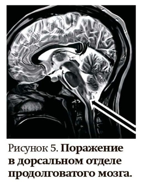 Заболевания спектра оптиконейромиелита                     
        Заболевания спектра оптиконейромиелита