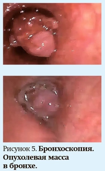 
        Кашель у детей: особенности дифференциальной диагностики                    