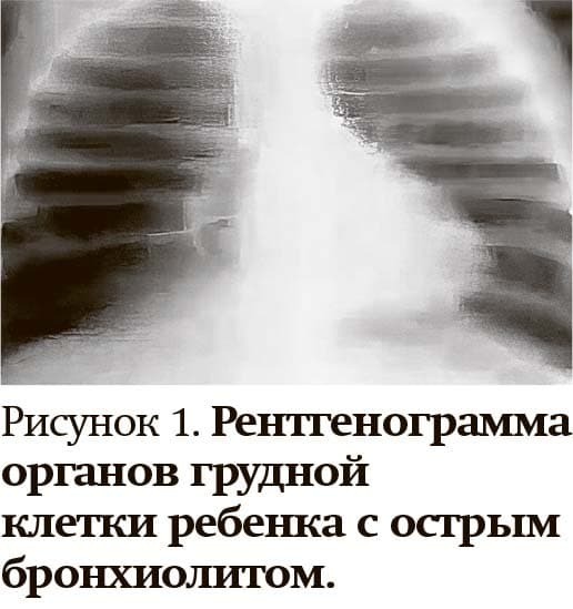 
        Кашель у детей: особенности дифференциальной диагностики                    
