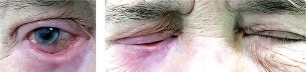 Особенности лечения пациентов с различными видами лагофтальма
Особенности лечения пациентов с различными видами лагофтальма