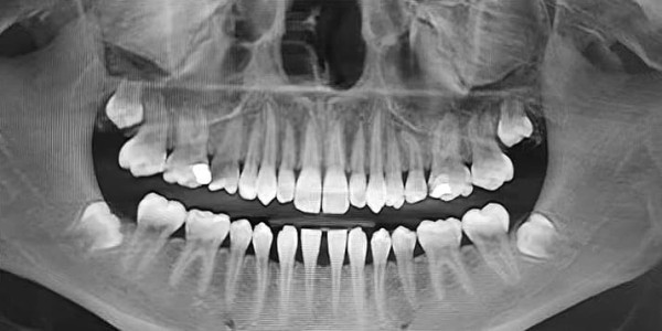 
        Надо ли удалять «восьмерки»? Как принять обоснованное решение                    
